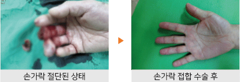 손가락 절단된 상태 ▶ 손가락 접합 수술 후
